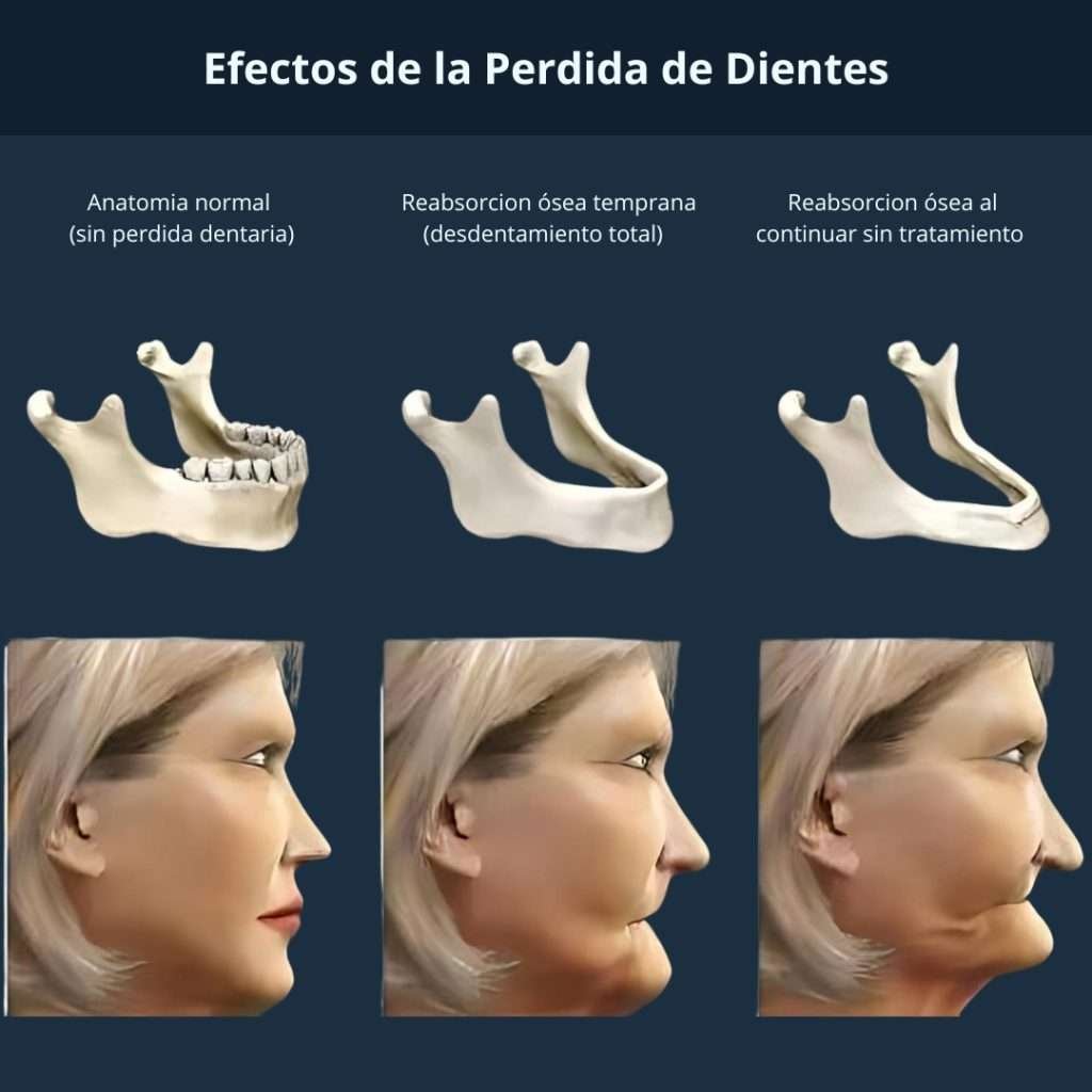efectos de la perdida de dientes y envejecimiento facial 