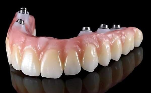 implantes dentales