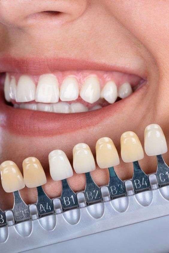 Blanqueamiento dental
