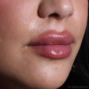 Resultado natural de relleno de labios en Santiago realizado por la Dra. Valentina Zamorano