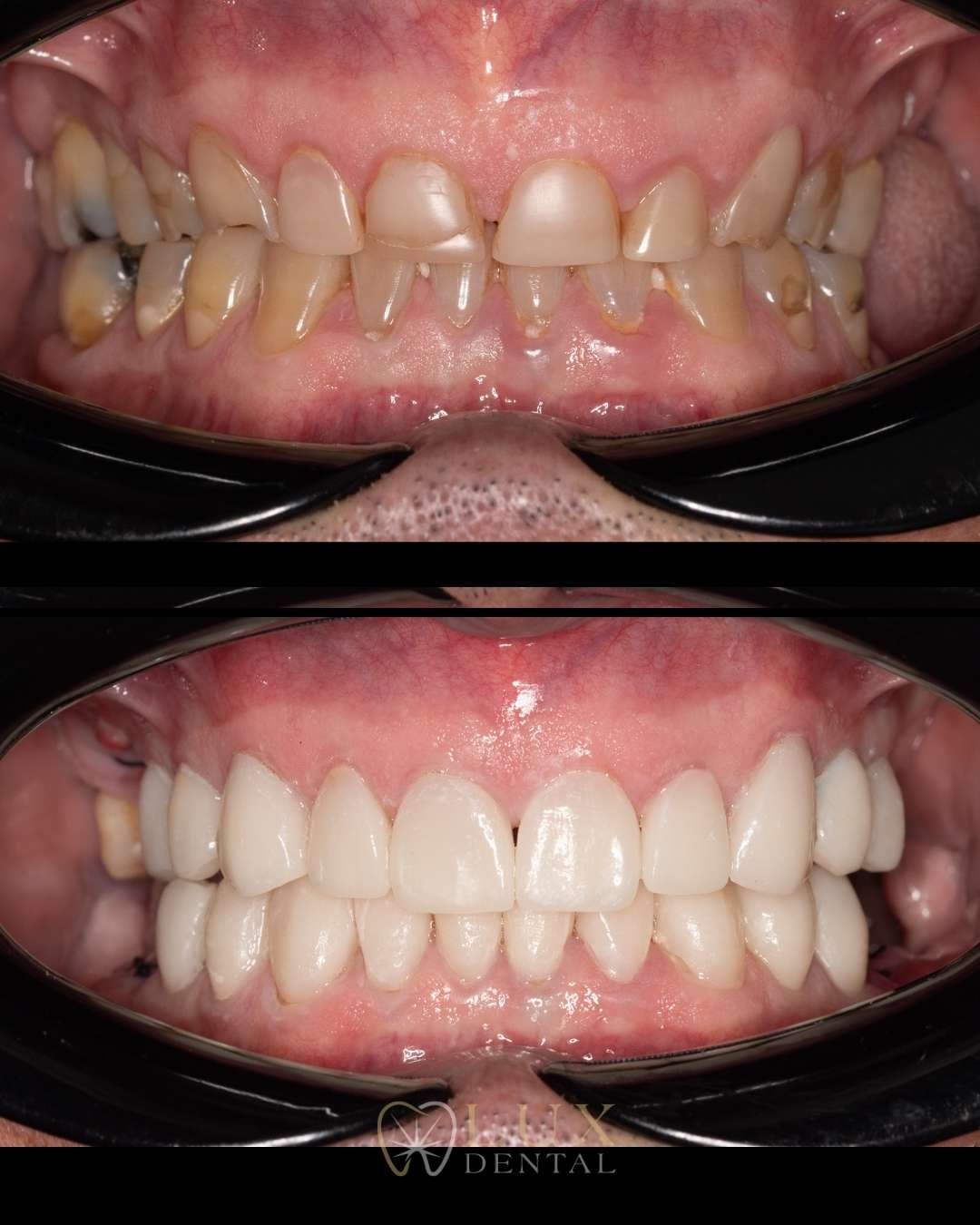 Diseño de sonrisa con carillas