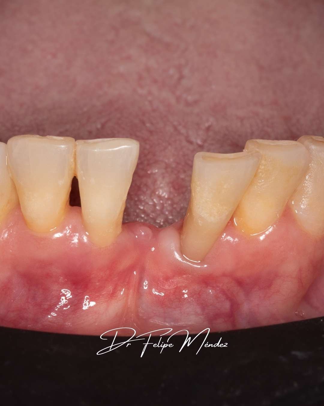 imagen intraoral de espacio sin diente antes de instalar puente Maryland