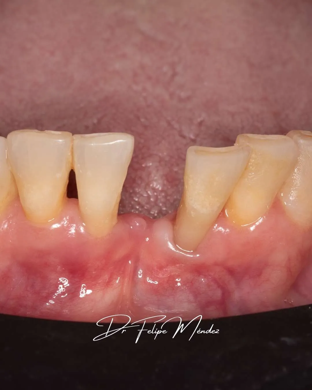 imagen intraoral de espacio sin diente antes de instalar puente Maryland