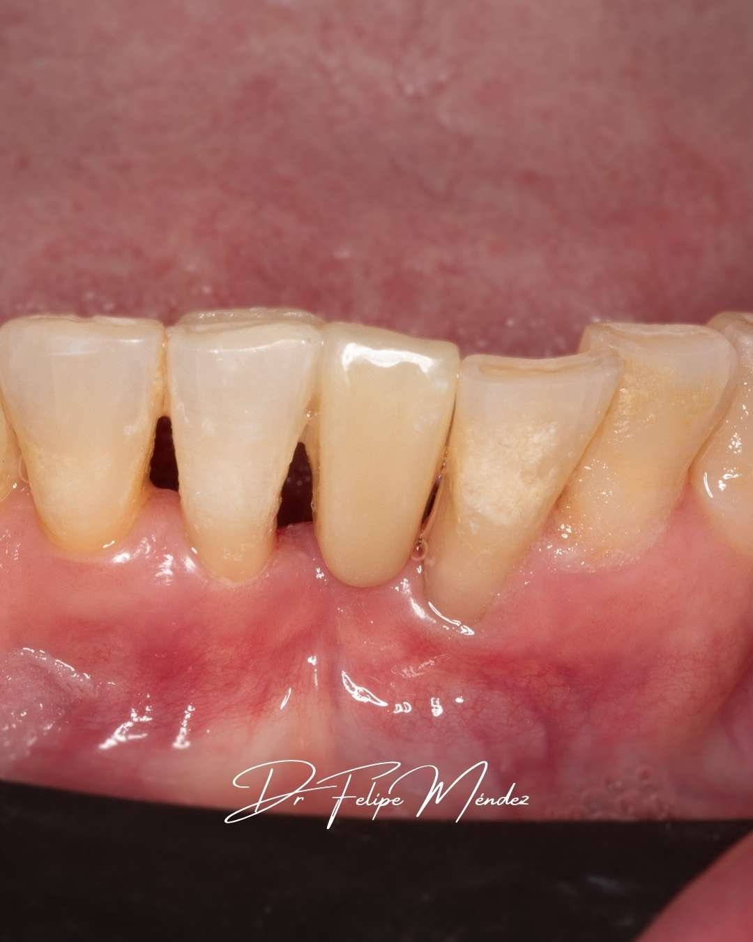 Resultado estético final de puente Maryland en diente inferior