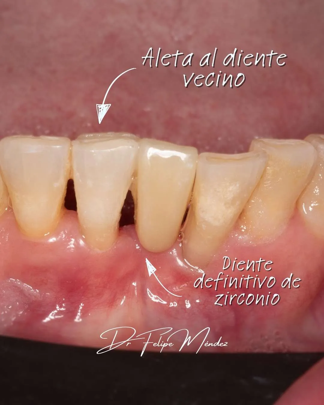Puente Maryland en boca con aleta adherida al diente vecino