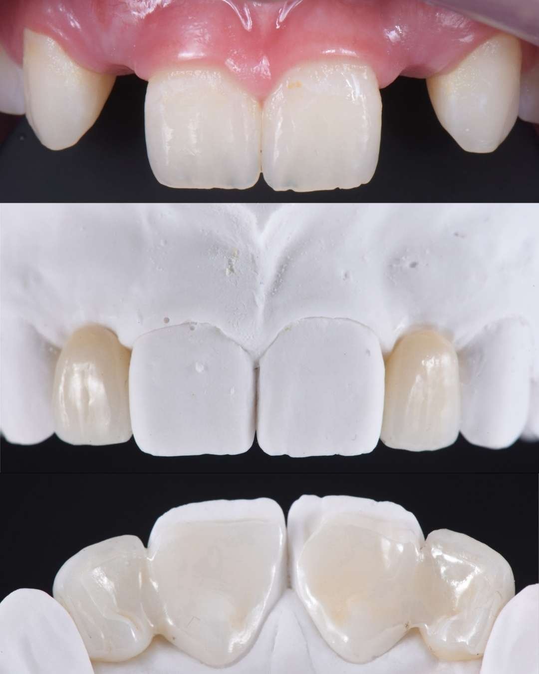 Modelo de yeso con prótesis tipo puente Maryland lista para cementación