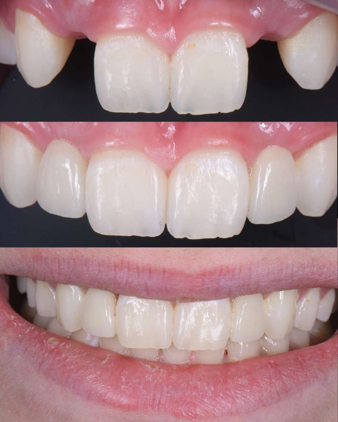 Paciente sonriendo con puente Maryland instalado en zona anterior