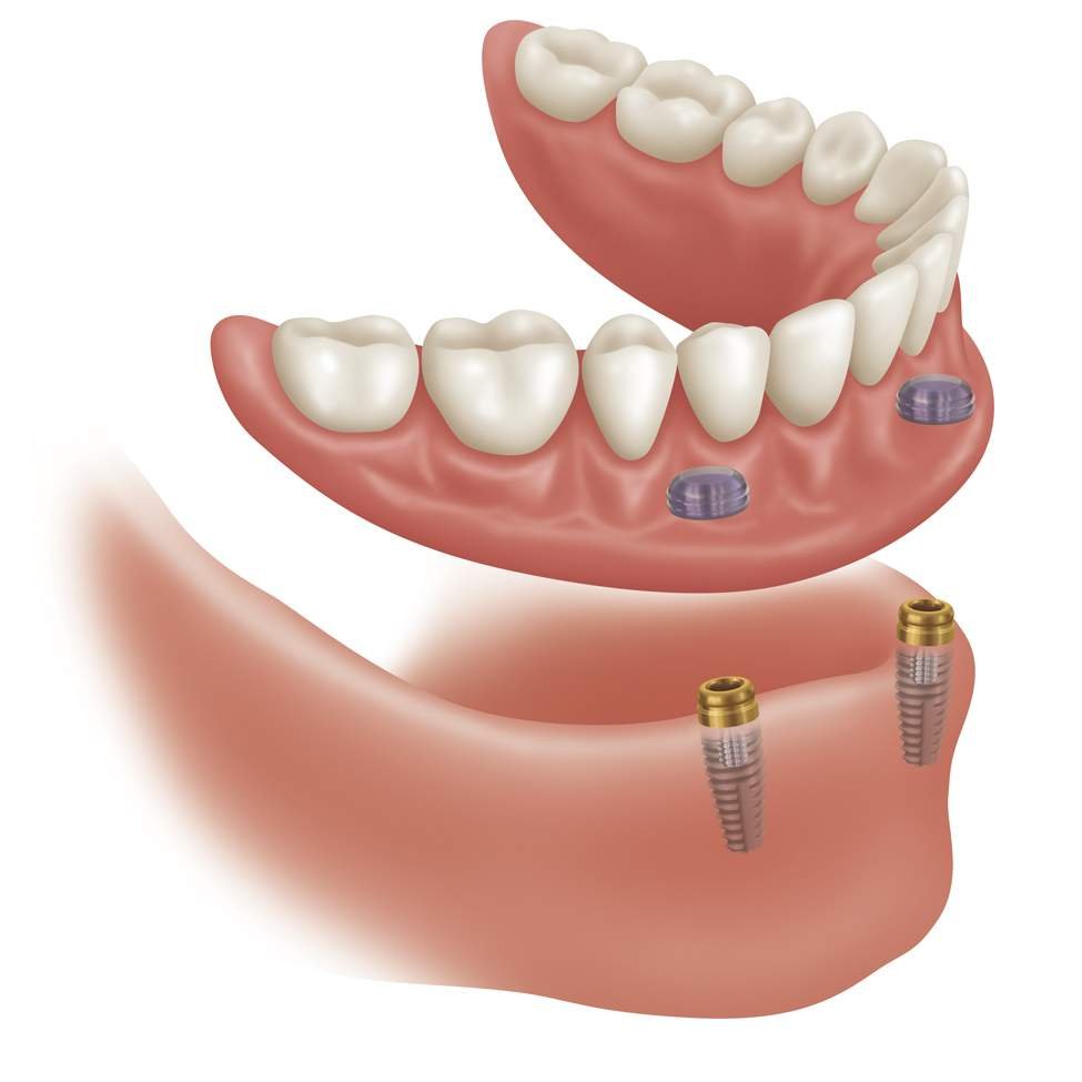 Sobredentadura sobre implantes con sistema Locator en Santiago — Lux Dental