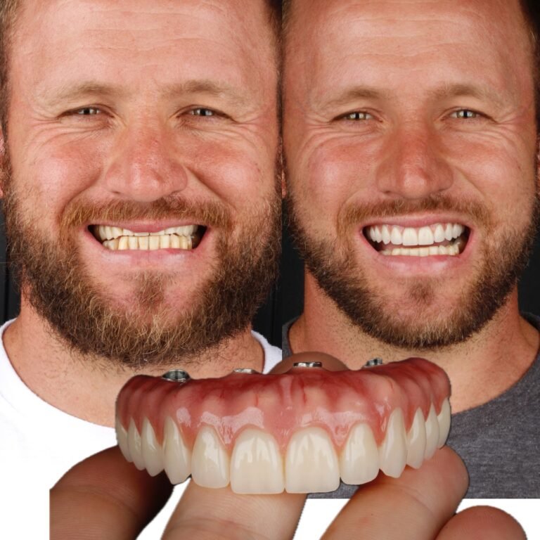 Antes y después de implantes dentales en Santiago Centro, Lux Dental