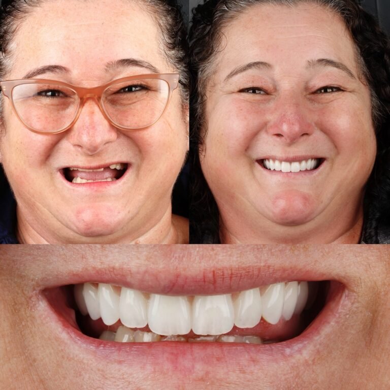 Antes y después de rehabilitación completa con implantes, Lux Dental Santiago