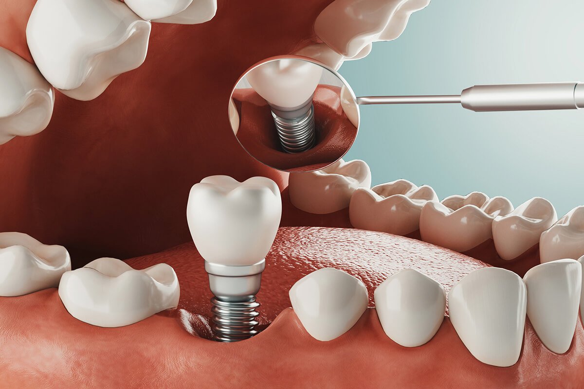 Implante dental unitario con corona, antes y después, Lux Dental Santiago