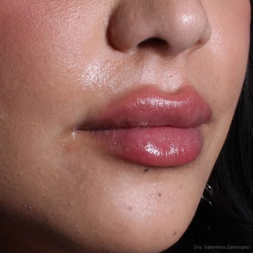 Resultado natural de relleno de labios en Santiago realizado por la Dra. Valentina Zamorano