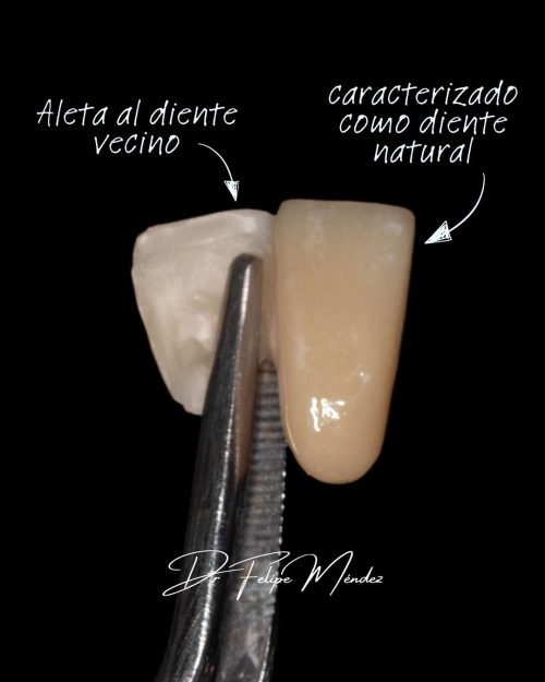 Vista de prótesis Maryland con estructura adhesiva y diente estético