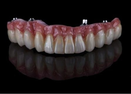 Prótesis Hibrida metal porcelana