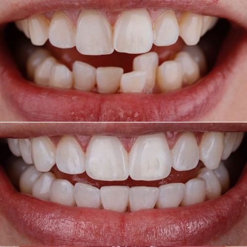 invisalign